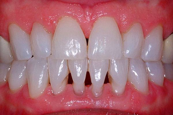 Blog What are Those Dark Spots Between Your Teeth